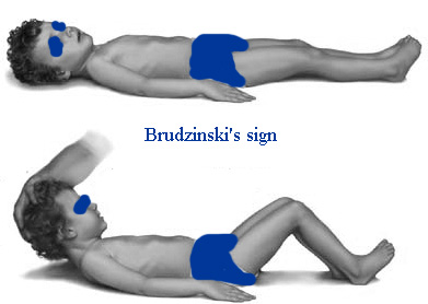 Brudzinski sign.jpg