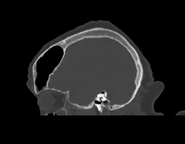 File:Pnumosinus ct.jpg