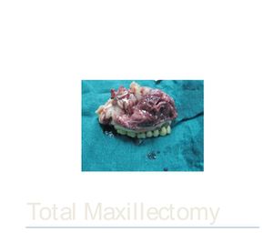 Maxillectomy.JPG