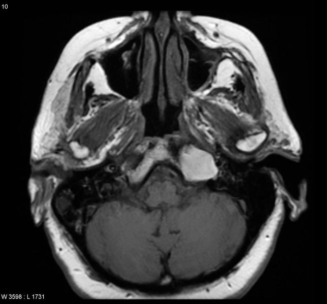 File:Cholesterol-granuloma.jpg