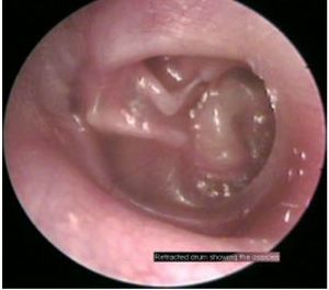 Endos otology.JPG