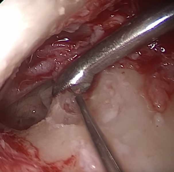 File:Curette.png